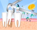 Removal of the patient`s tooth. Dental surgery. Enamel damage, tooth infection, bacteria. Dentistry, treatment of toothache. Vecto